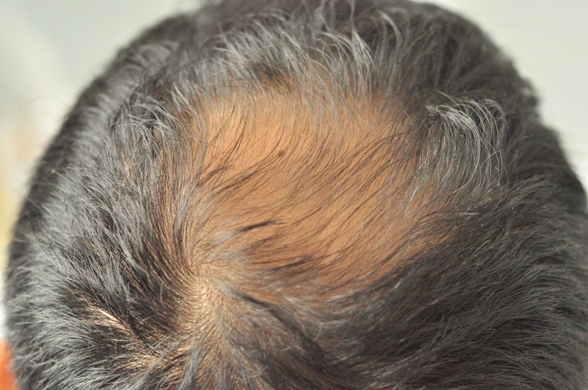 Receding Hairline: Causes, Stages, Treatment, & Hairstyles – Traya
