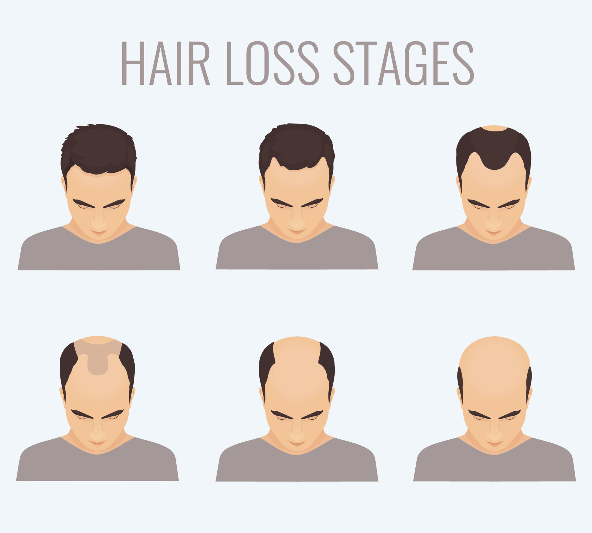 Male Pattern Baldness | Vegas Valley Hair Restoration
